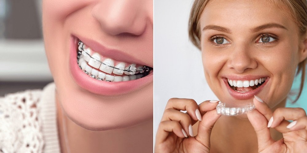 Affordable Orthodontist Care for a Healthier Smile