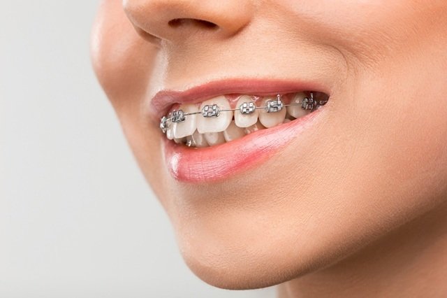 Everything You Need to Know About Dental Orthodontics